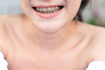 The smile on the face of the girl, Braces concept