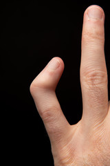 Orthopedic medicine, broken bone. Close-up back view of a broken and deformed little finger,...
