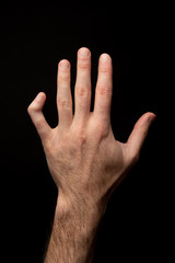 Orthopedic medicine. Back view of a broken and deformed little finger of a male hand, external...