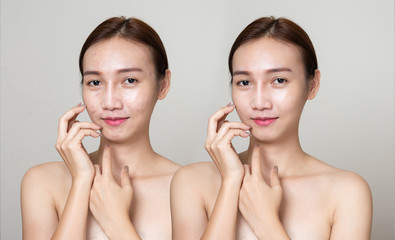 Women face with acne before and after treatment. Comparison portrait of asian girl with problematic pimple skin without and with makeup