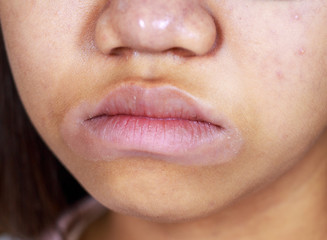 Asian teenage girl has skin marks around their mouth peeling off.