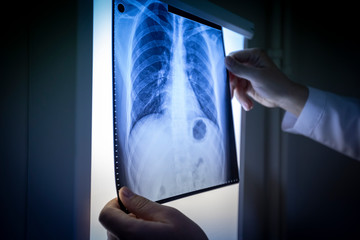 Doctor checking x ray film and examining lungs