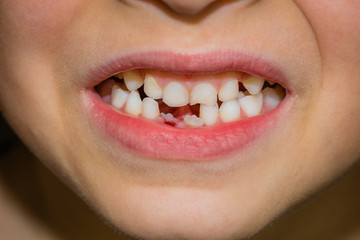 A young boy lost his milk tooth After a few days his first adulth tooth started to show.