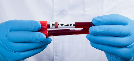 Coronavirus 2019-nCoV Blood Sample.