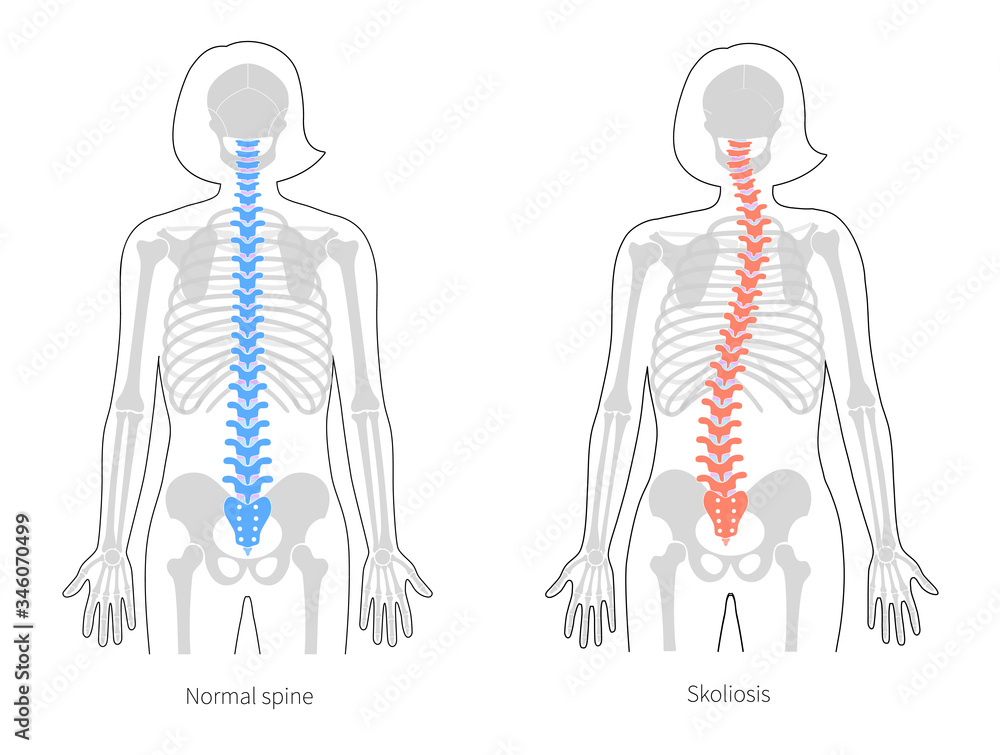 Canvas Prints Scoliosis flat vector illustration