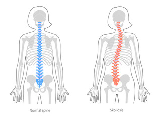 Scoliosis flat vector illustration
