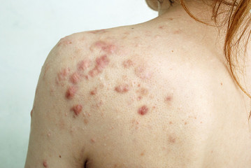 Keloids and scars on the back after treating acne problems in young. problems and treatment of acne...