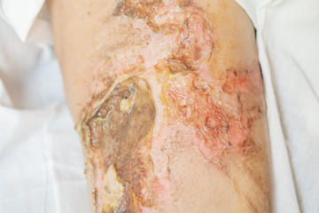 Blisters. From the fire And skin inflammation and burning symptoms