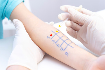 Allergen test on hand. child undergoing procedure of allergen skin test in clinic.
