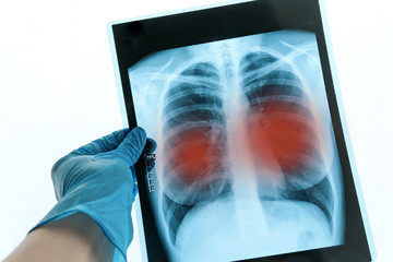 Medical doctor looking at x-ray picture of lungs in hospital. Covid-19 consept