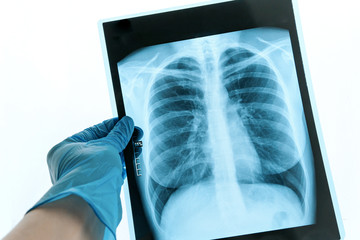 Doctor with radiological chest x-ray film for medical diagnosis on patient’s health on COVID-19....