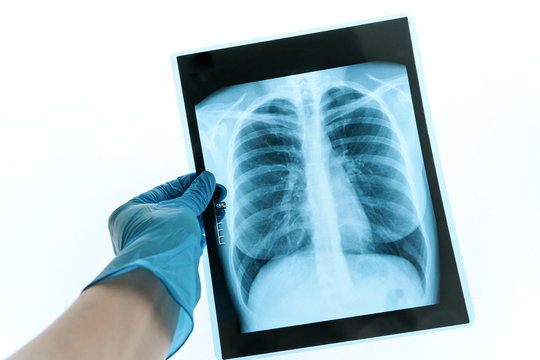Medical doctor looking at x-ray picture of lungs in hospital. Covid-19 consept