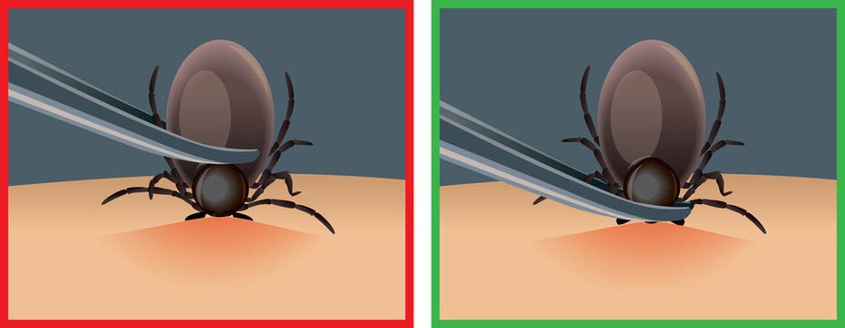 how to get a tick correctly. Mite parasites. Tick parasite removing by tweezers vector illustration. Mite parasites. Acarus. Mite spider. Mite epidemic.