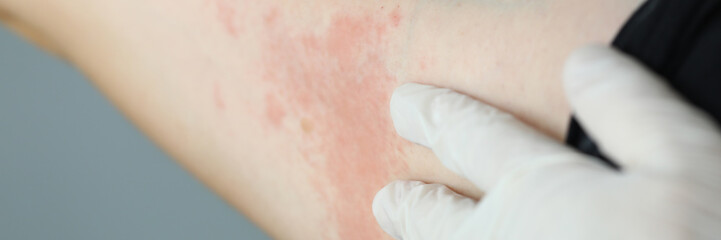 Close-up red rash on white skin hand, examination