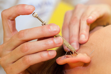 acupuntura, fisioterapeuta, oreja, aguja