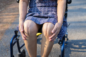 Asian senior or elderly old lady woman patient show her scars surgical total knee joint replacement...