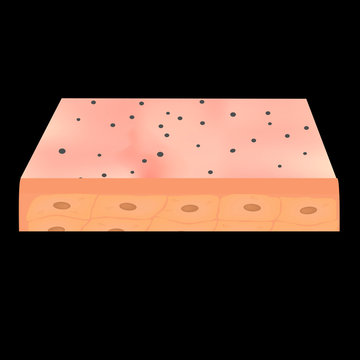 Open comedones. Acne on the skin. Dermatological and cosmetic diseases on the skin of the face acne. Infographics. Vector illustration on isolated background.