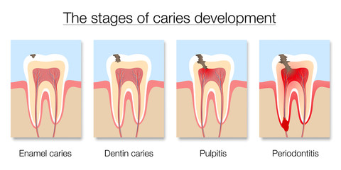 Caries stages chart, development of tooth decay with enamel and dentin caries, pulpitis and periodontitis. Isolated vector illustration on white background.
