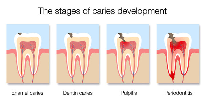 Caries stages chart, development of tooth decay with enamel and dentin caries, pulpitis and periodontitis. Isolated vector illustration on white background.
