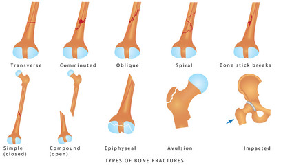 Types of Bone Fractures. Different kinds of fractures. Descriptive illustration with examples of fractures of the femur bone on white background