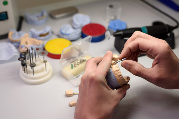 Close-up of a dental technician holding a tooth model in his hands and screwing an implant for a...