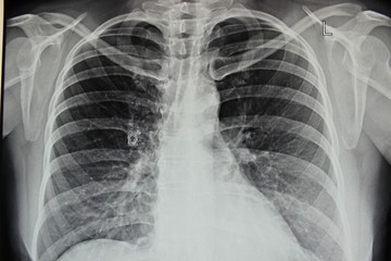 x ray of a chest