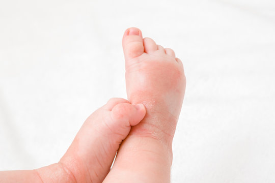 Infant legs with red dry skin. Suffering from allergy of milk formula or other food. Closeup.