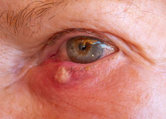 Augenkrankheit Gerstenkorn