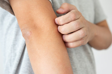 Fototapeta premium Young asian man itching and scratching on arm from itchy dry skin eczema dermatitis