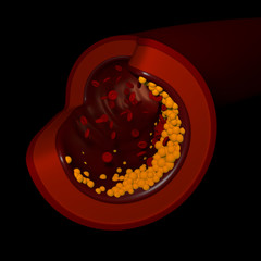 3d Illustration of a Vein With Cholesterol Formation Front View