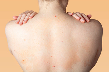 Allergic dermatitis on the skin of a woman's back. Skin disease. Neurodermatitis disease, eczema or allergy rash. Healthcare and Medical.
