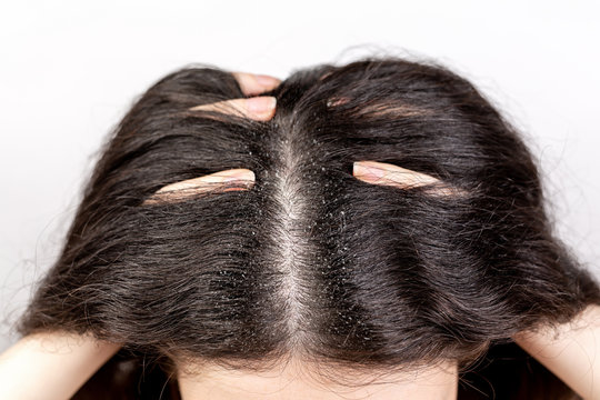 The woman holds her head with her hands, showing a parting of dark hair with dandruff. Close up. The view from the top. White background. Copy space. The concept of dandruff and pediculosis