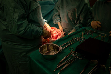 a surgical team performs a surgical abdominal operation