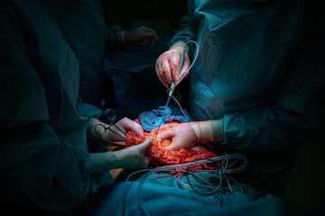 a surgical team performs a surgical abdominal operation