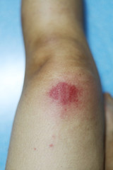 Fototapeta premium Insect bite wounds at leg in thailand