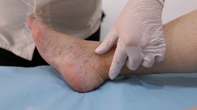 Chinese doctor doing acupuncture on the foot of a patient
