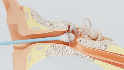 3d render ear cleansing ear stick. cleansing earwax with an ear stick