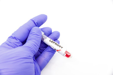 Obraz premium Closeup of microbiologist or medical worker hand with blue surgical gloves marking blood test result as positive for the leprosy. Leprosy Positive concept