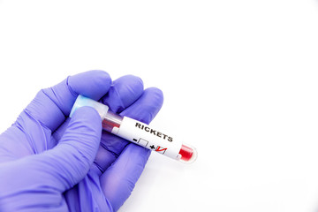 Obraz premium Closeup of microbiologist or medical worker hand with blue surgical gloves marking blood test result as positive for the rickets. Rickets Positive concept