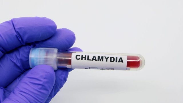 Closeup of microbiologist or medical worker hand with blue surgical gloves marking blood test result as positive for the chlamydia. Chlamydia Positive concept