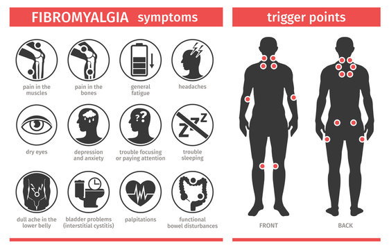 Symptoms and signs of fibromyalgia. Tender points. Infographic. Template for use in medical agitation. Vector illustration, flat icons.