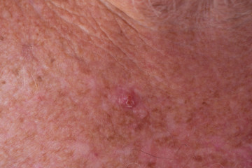 BCC skin cancer on chest of senior male