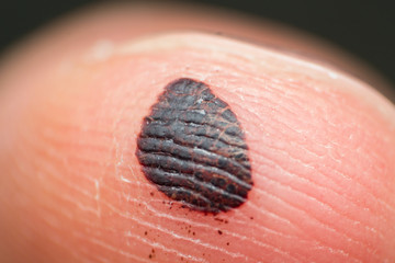 Subcutaneous hematoma close up. Finger injury trauma cause by hitting the finger with a hammer....