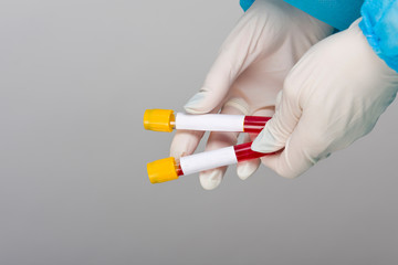 Hands holding test tube with blood plasma ready for testing