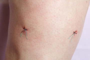 Arthroscopy or arthroscopic meniscectomy surgical suture of a man's knee in the hospital
