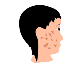 Pigmentation on the skin. A pigmented spot on the skin of the face. Vector illustration