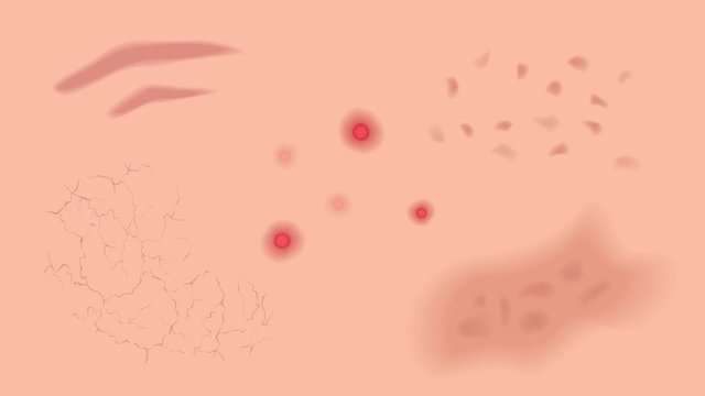 pus acne pimple freckle chloasma burn aging dry  and ringworm graphic animation