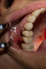 Obraz premium repositioning gingival tissue
