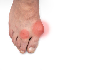 Varus valgus and Hallux valgus, bunion on white background. Empty space.