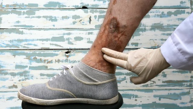 Bad leg and Illness of human skin. Scratch scars, ulcers and age spots, possibly after varicose veins on his leg. Close up.